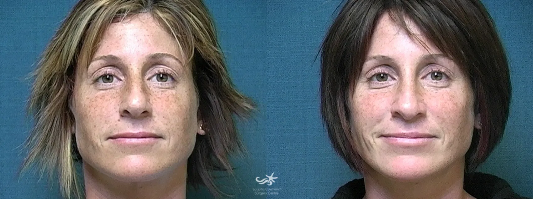 Before & After Rhinoplasty Result 533 Front View in San Diego, CA
