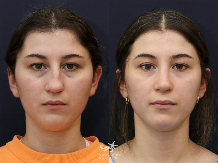 Before & After Rhinoplasty Result 625 Front View in San Diego, Carlsbad, CA