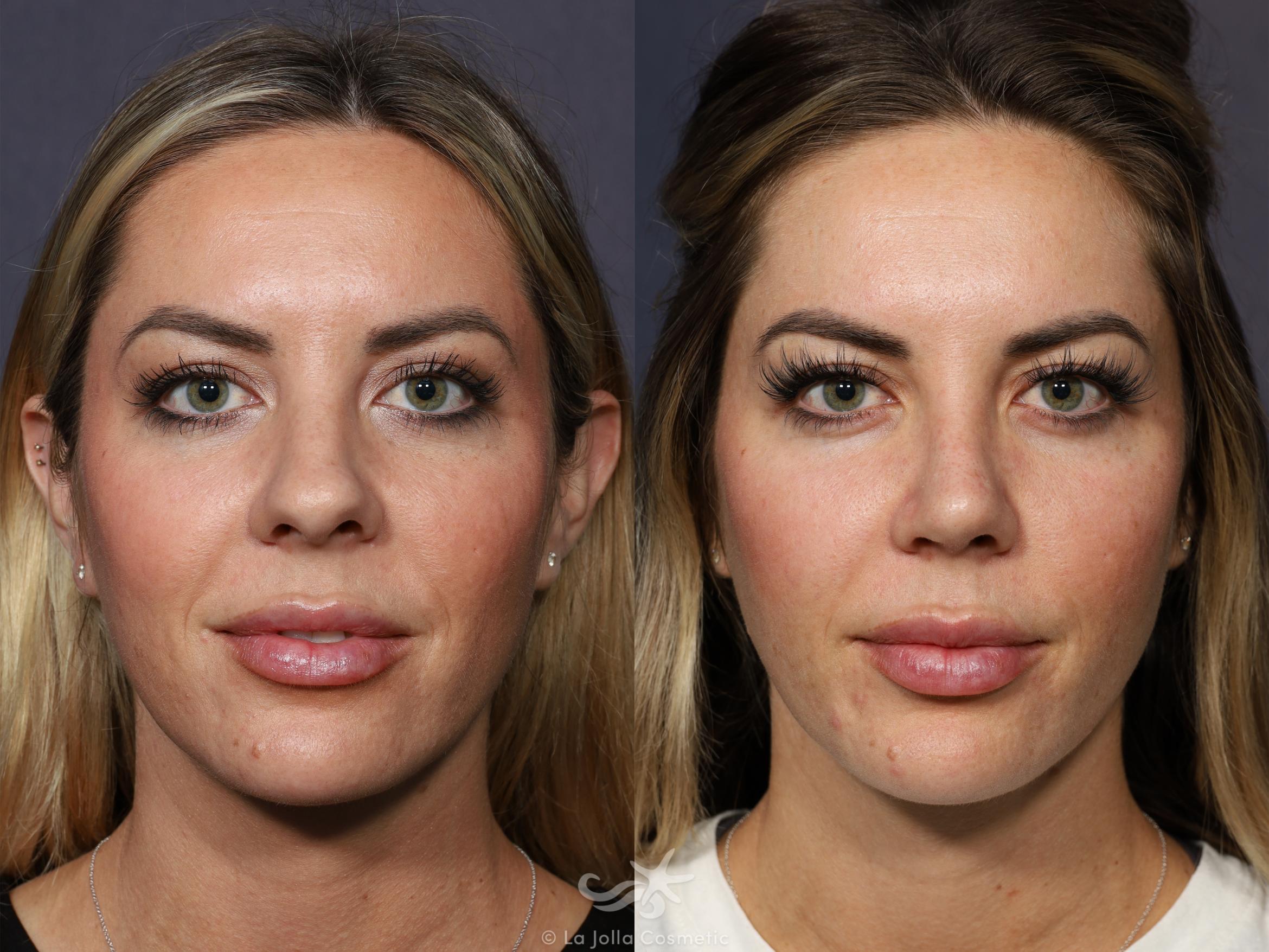 Before & After Rhinoplasty Result 731 Front View in San Diego, CA