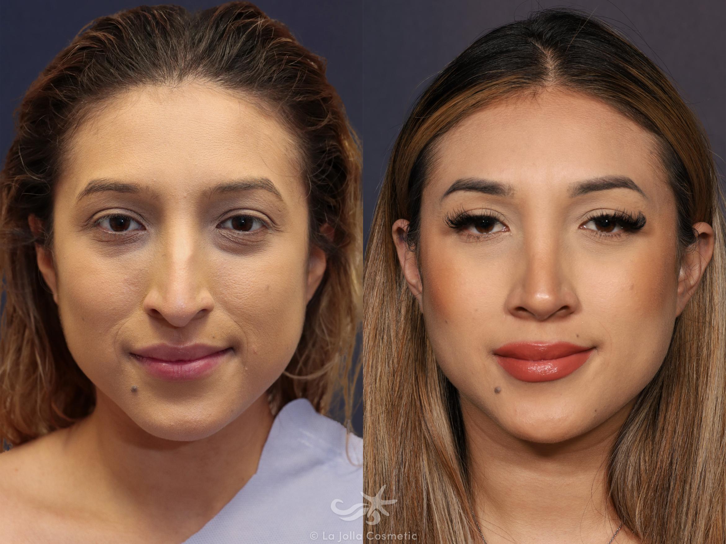 Before & After Rhinoplasty Result 795 Front View in San Diego, CA