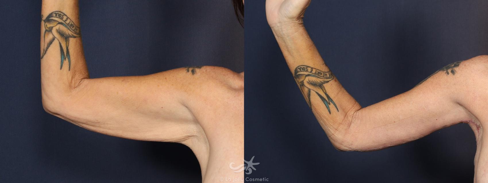 Before & After Upper Arm Lift Result 1019 Front View in San Diego, CA