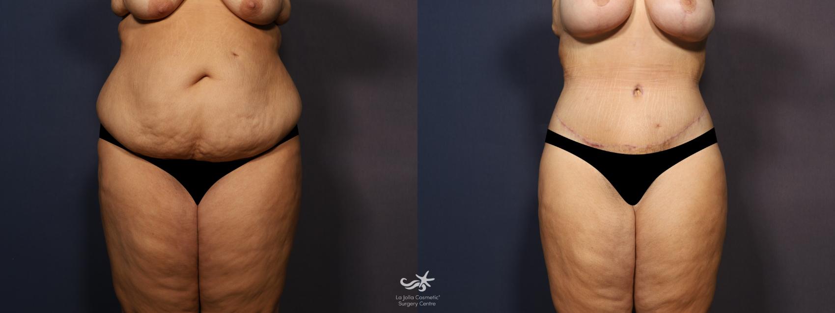 Before & After Body Lift Result 1236 Front View in San Diego, CA