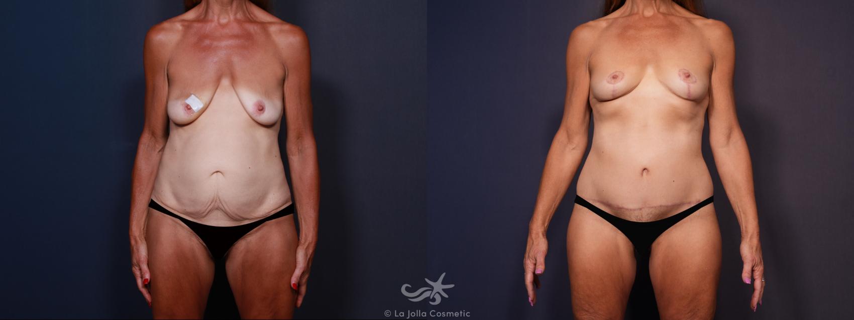 Before & After Body Lift Result 605 Front View in San Diego, Carlsbad, CA