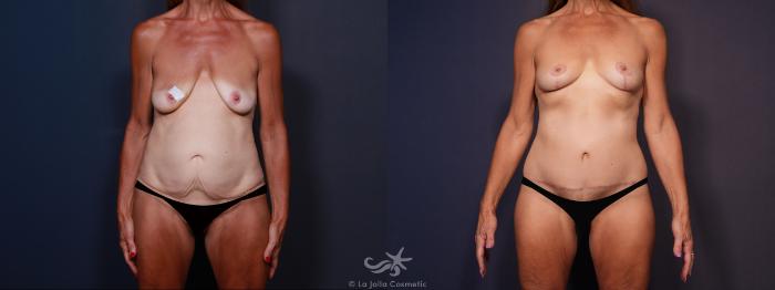 Before & After Tummy Tuck Result 605 Front View in San Diego, Carlsbad, CA