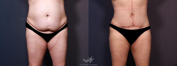 Before & After Body Lift Result 705 Front View in San Diego, Carlsbad, CA
