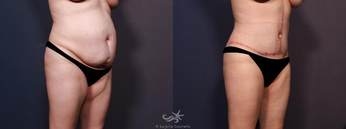 Before & After Body Lift Result 705 Right Oblique View in San Diego, Carlsbad, CA