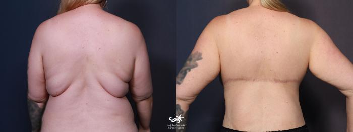 Back Lift (Upper Body Lift) Before and After Pictures Case 11684, Golden,  CO