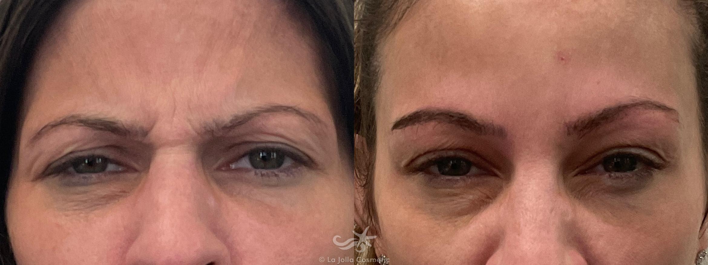 Before & After BOTOX® Result 662 Front View in San Diego, CA