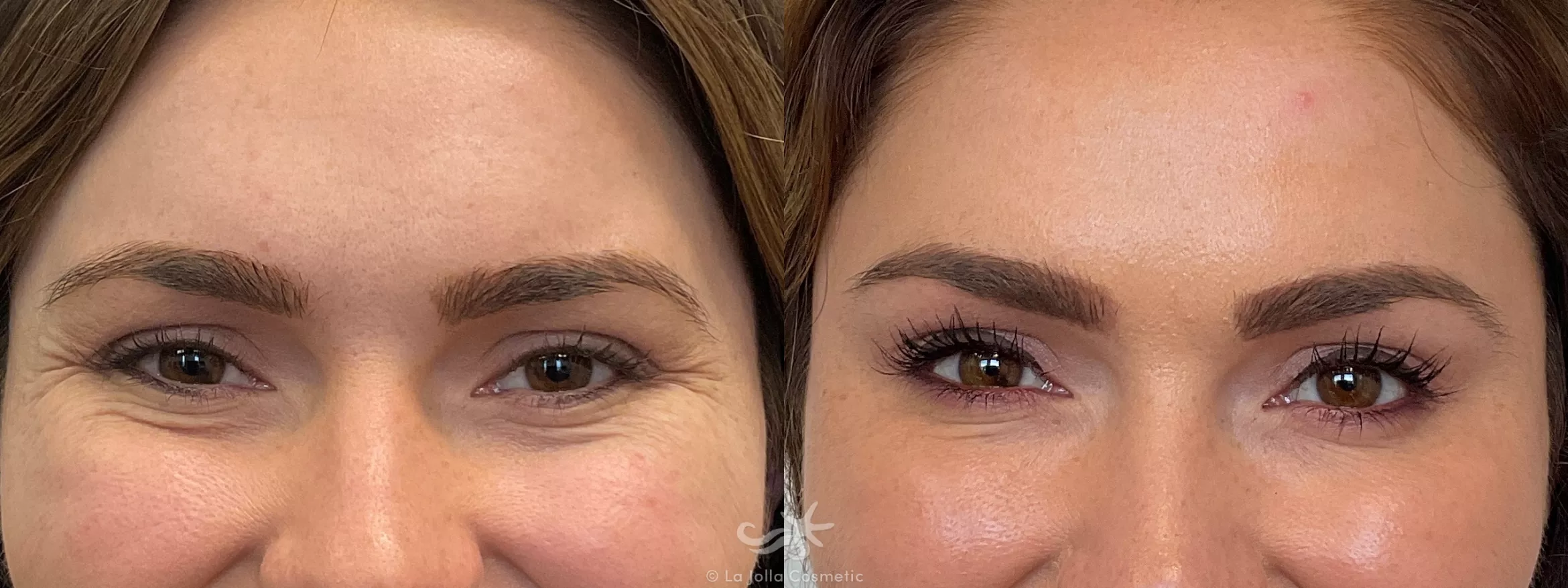 Before & After BOTOX® Cosmetic Result 691 Front View in San Diego, CA
