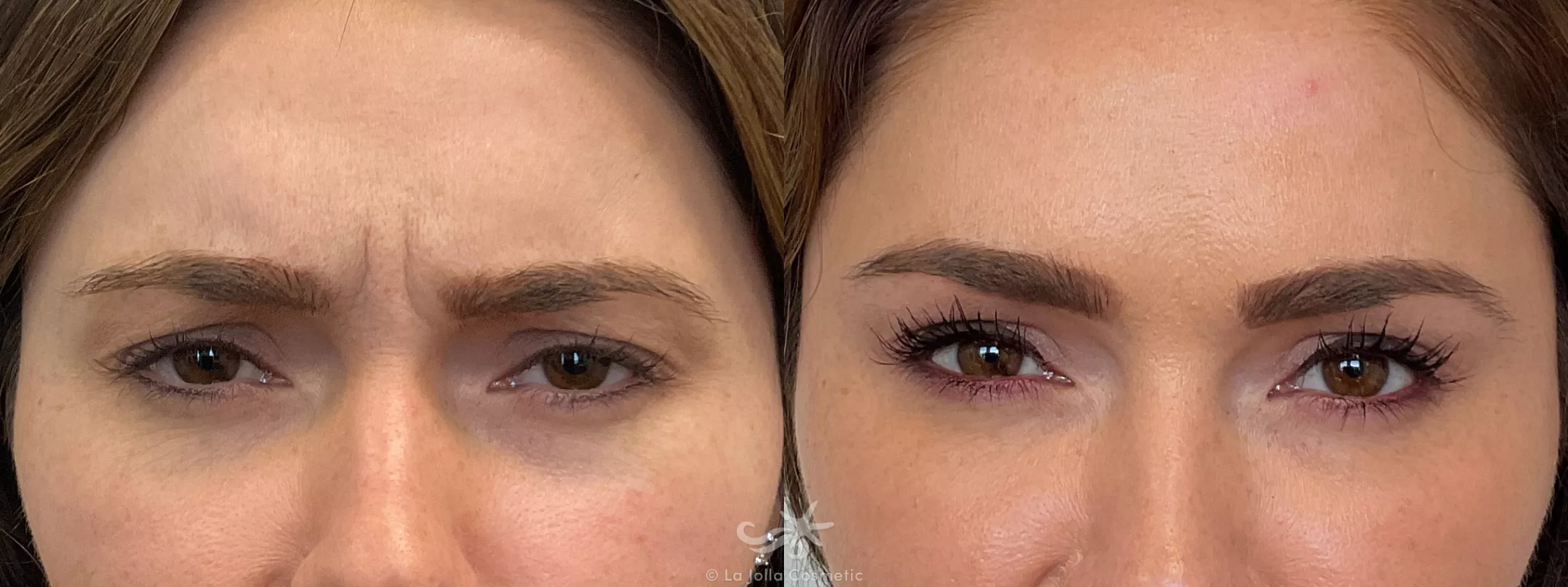 Before & After BOTOX® Cosmetic Result 691 Front Glabellar View in San Diego, CA