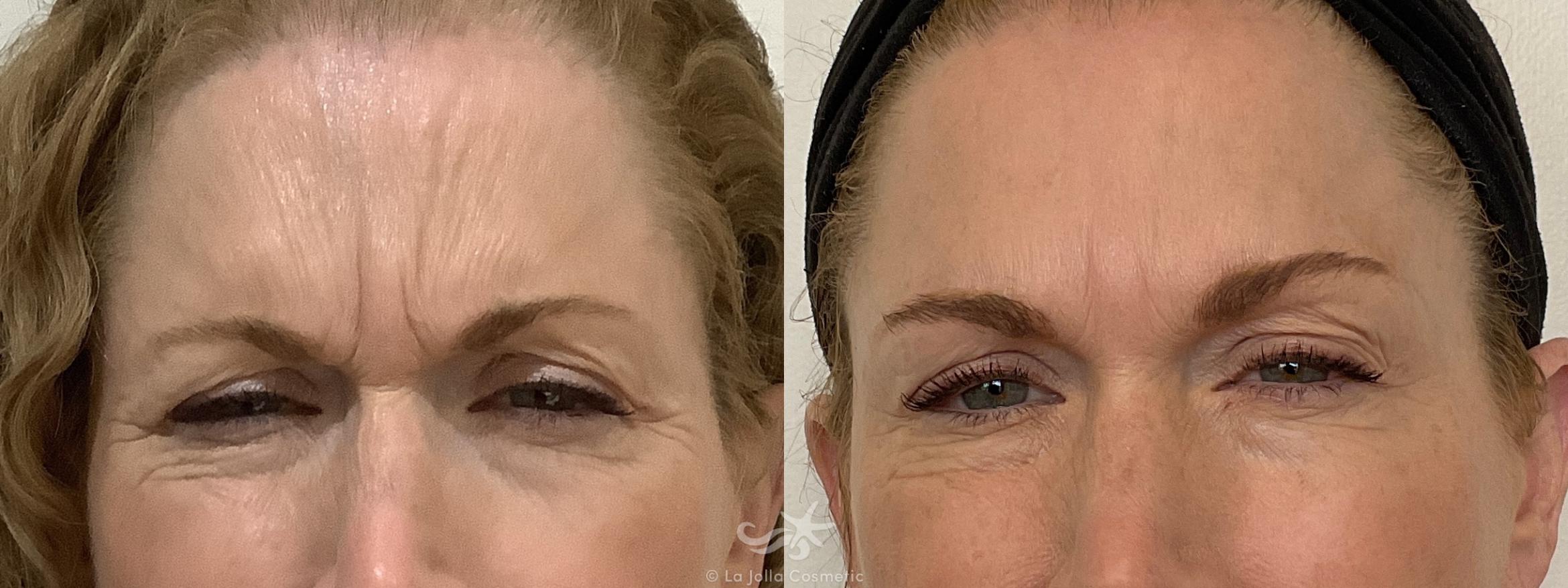 Before & After Botox® Result 693 Front View in San Diego, CA