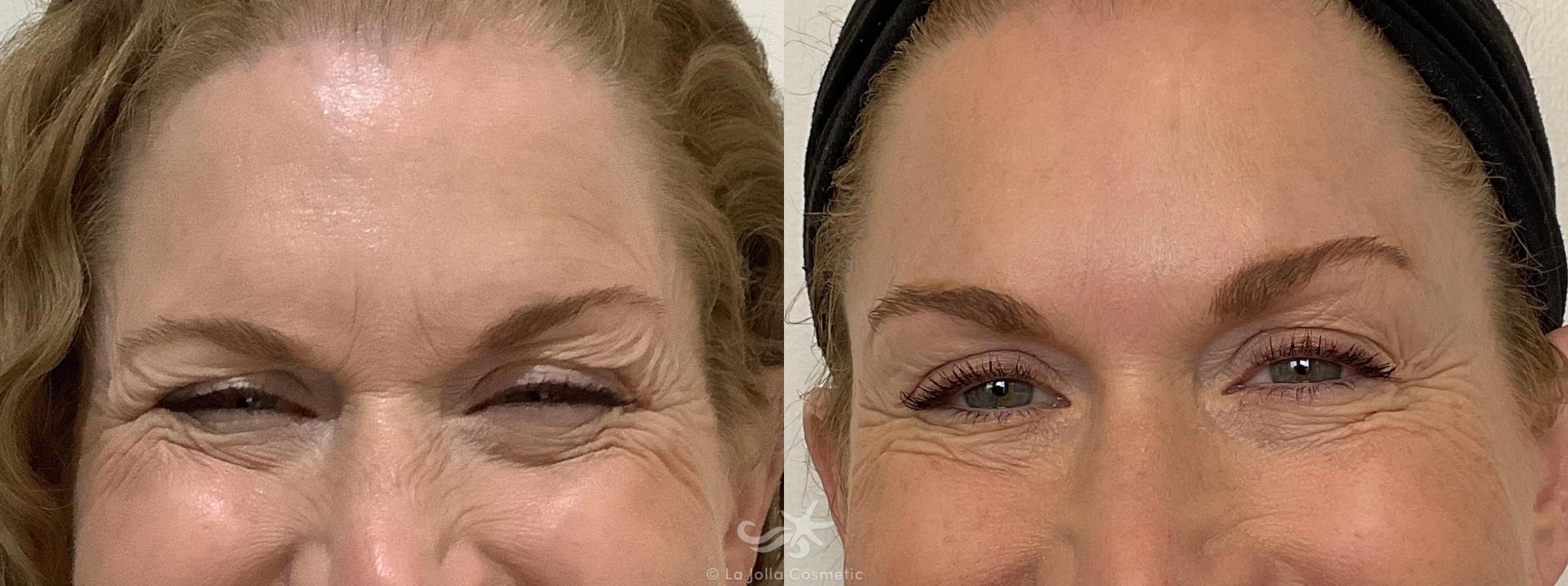 Before & After Botox® Result 693 Front Smile View in San Diego, CA