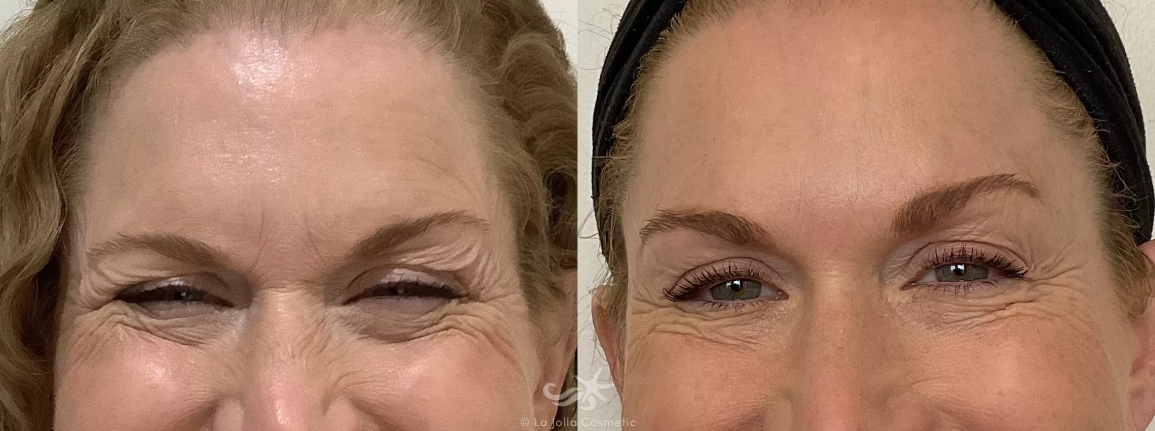 Before & After BOTOX® Cosmetic Result 693 Front Smile View in San Diego, CA