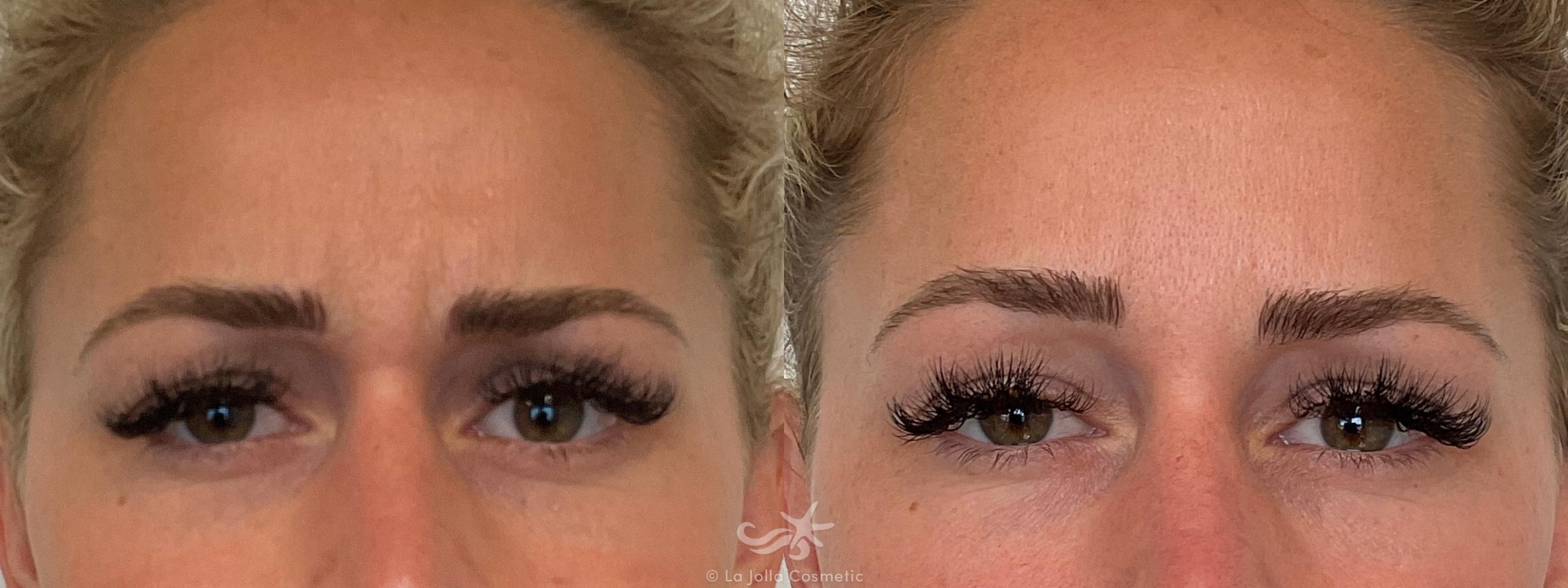 Before & After Botox® Result 696 Front View in San Diego, CA