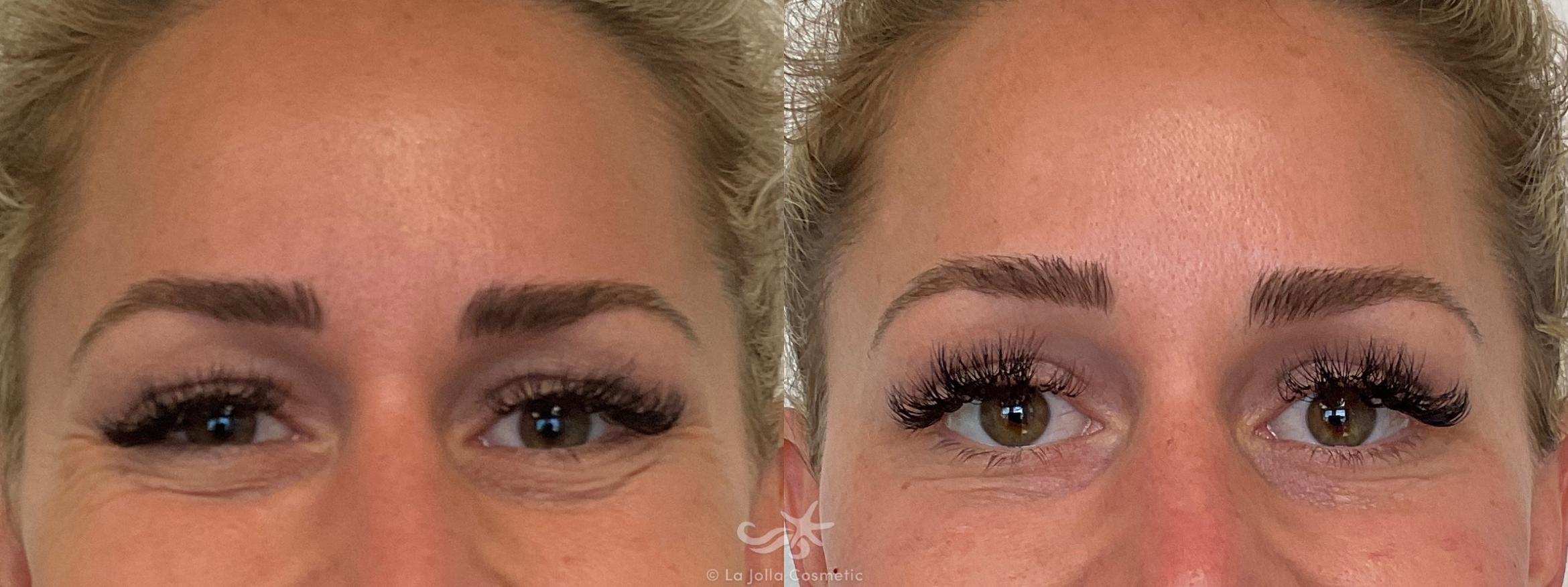 Before & After Botox® Result 696 Front Smile View in San Diego, CA