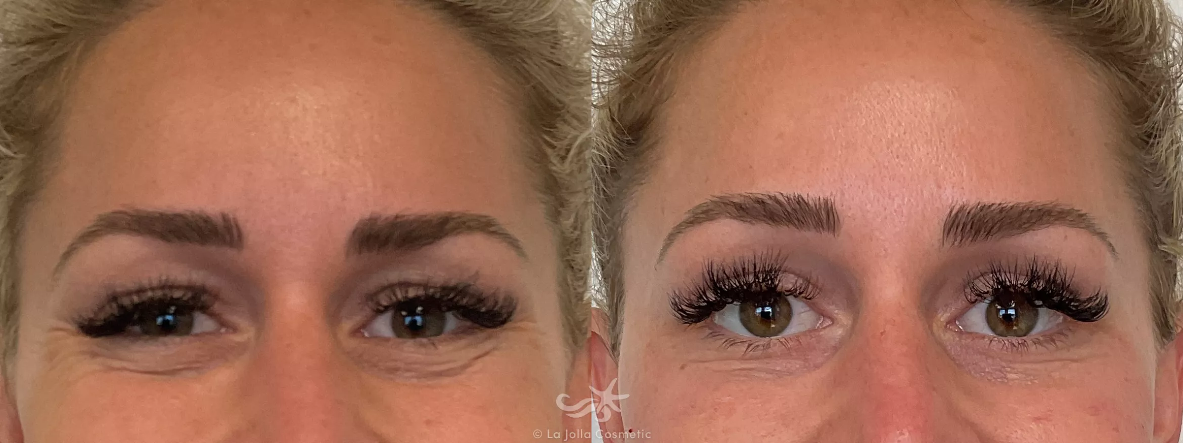 Before & After BOTOX® Cosmetic Result 696 Front Smile View in San Diego, CA