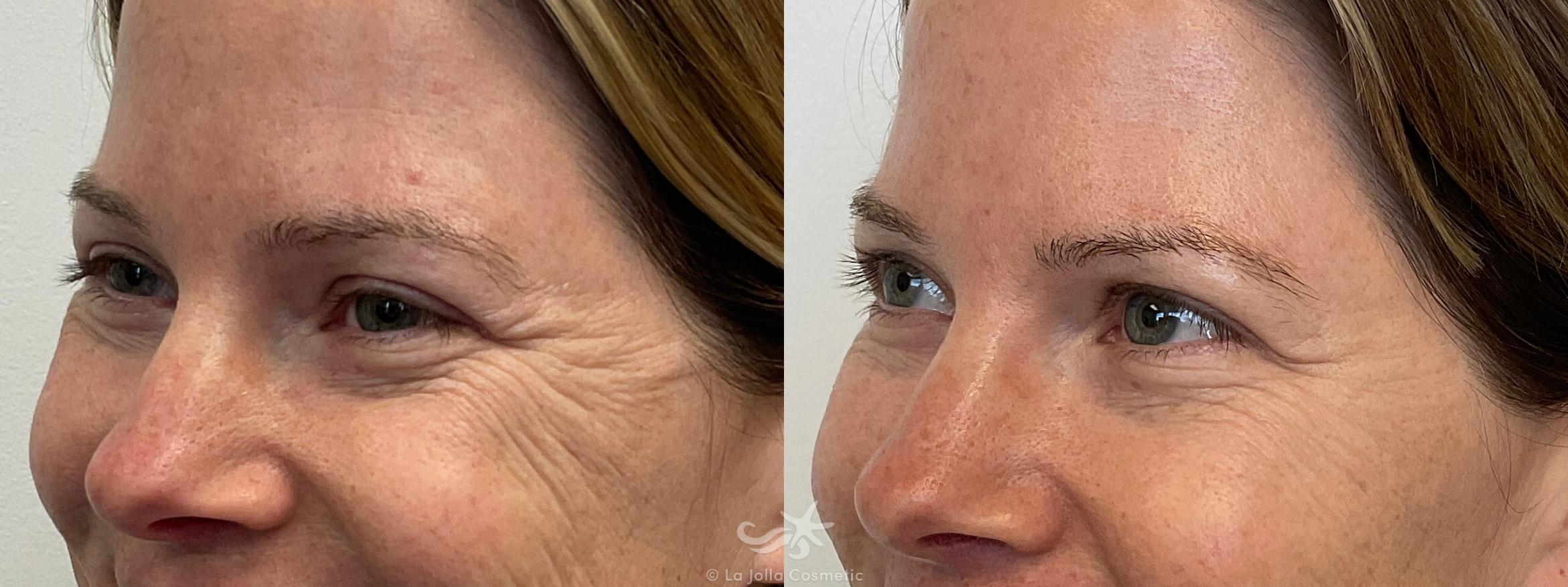 Before & After Botox® Result 698 Left Oblique View in San Diego, CA