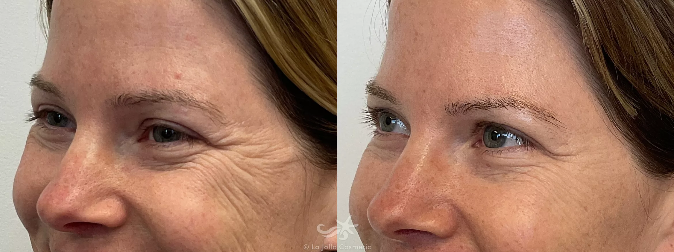 Before & After BOTOX® Cosmetic Result 698 Left Oblique View in San Diego, CA