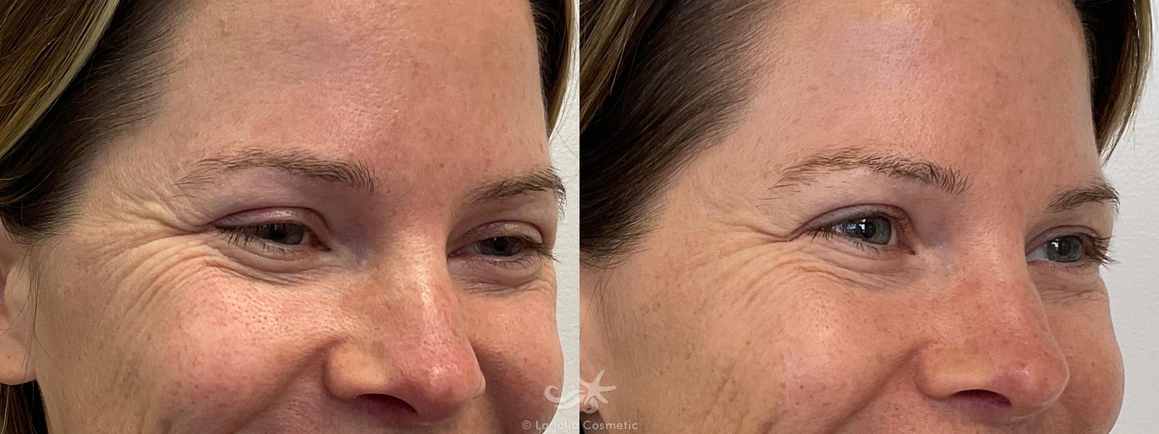Before & After Botox® Result 698 Right Oblique View in San Diego, CA