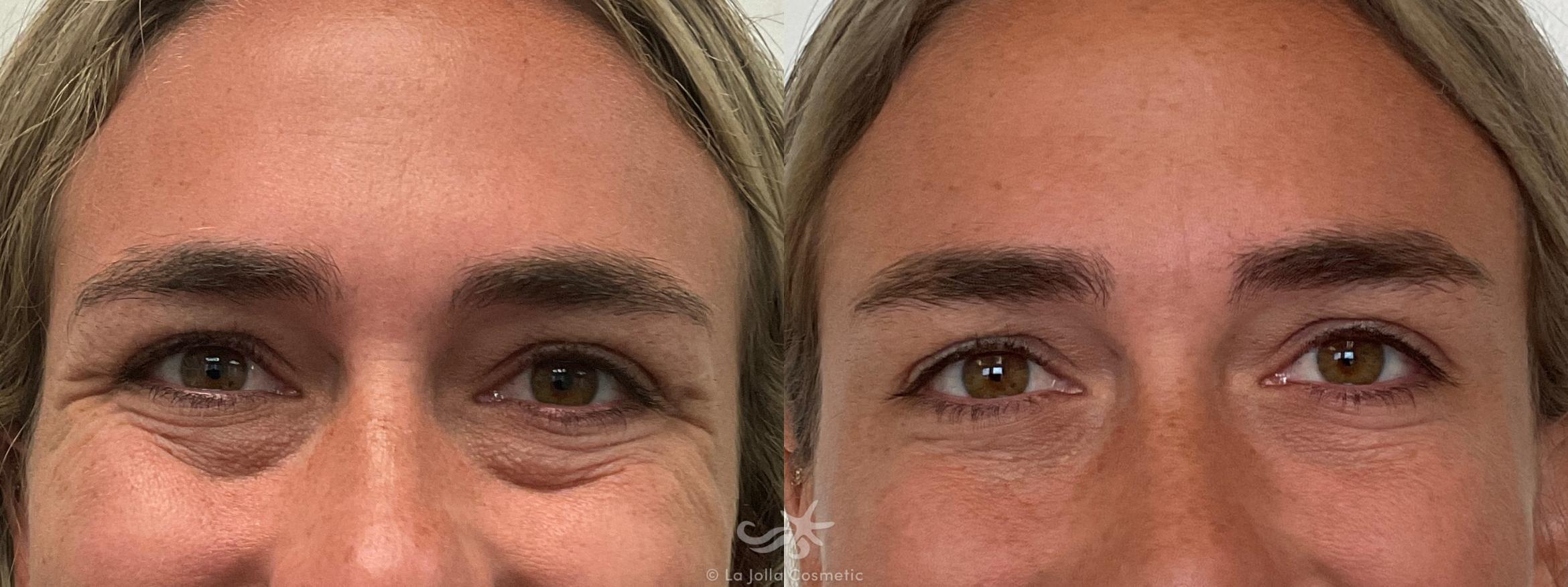 Before & After Botox® Result 707 Front View in San Diego, CA