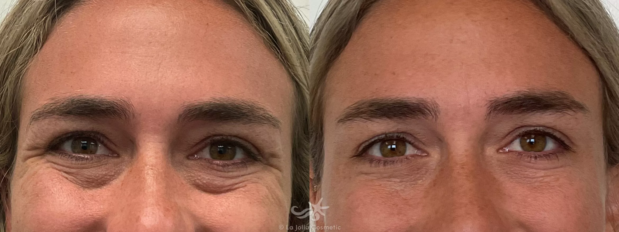 Before & After BOTOX® Cosmetic Result 707 Front View in San Diego, CA