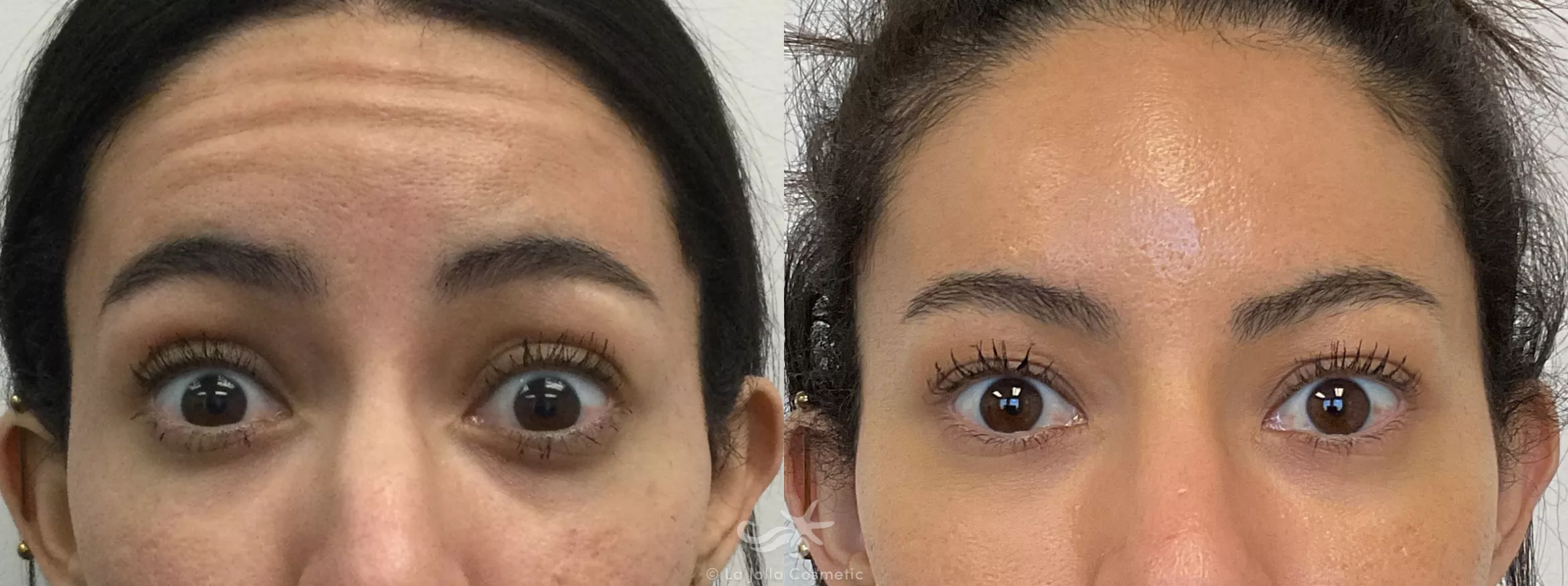 Before & After BOTOX® Cosmetic Result 709 Front View in San Diego, CA