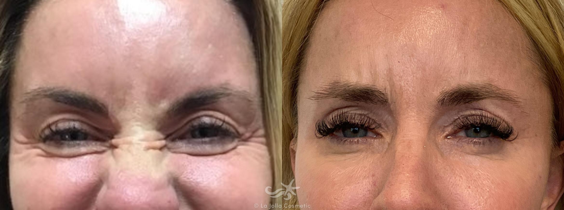 Before & After Botox® Result 719 Front View in San Diego, CA