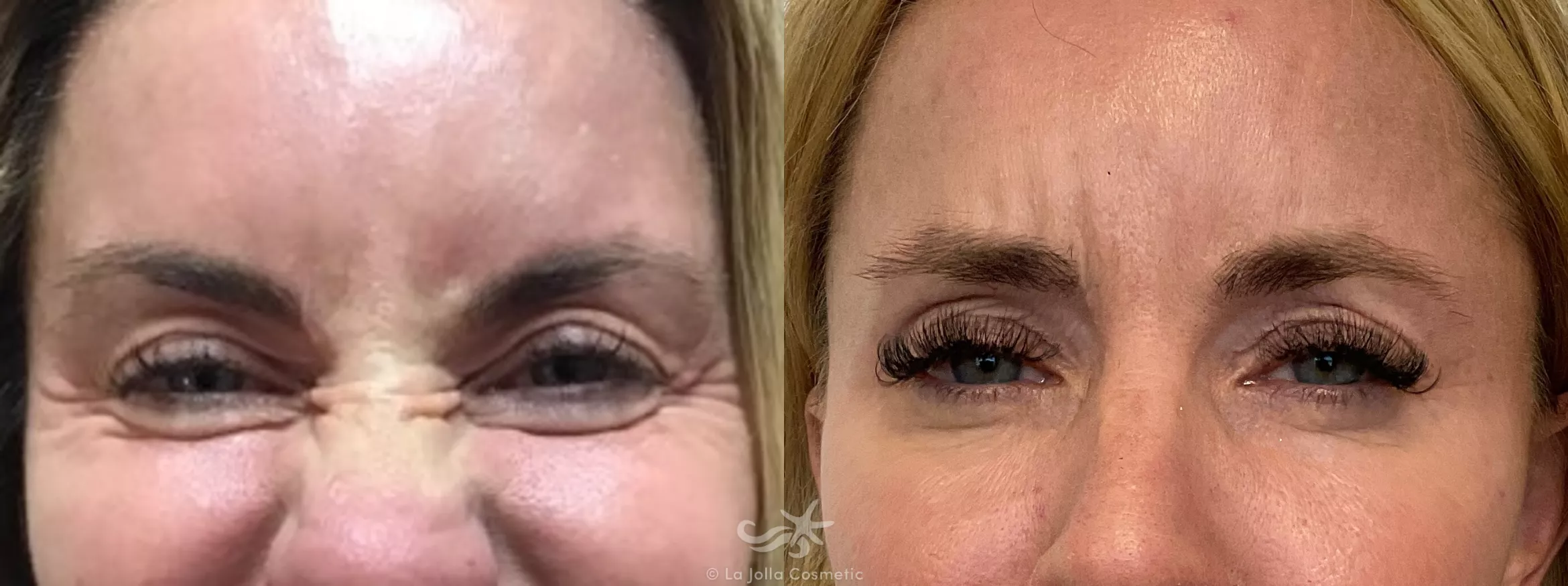 Before & After BOTOX® Cosmetic Result 719 Front View in San Diego, CA