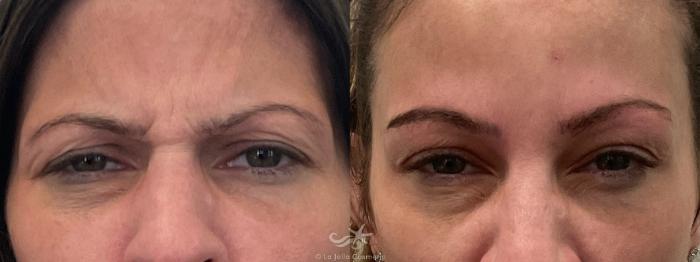 Before & After BOTOX® Cosmetic Result 662 Front View in San Diego, Carlsbad, CA