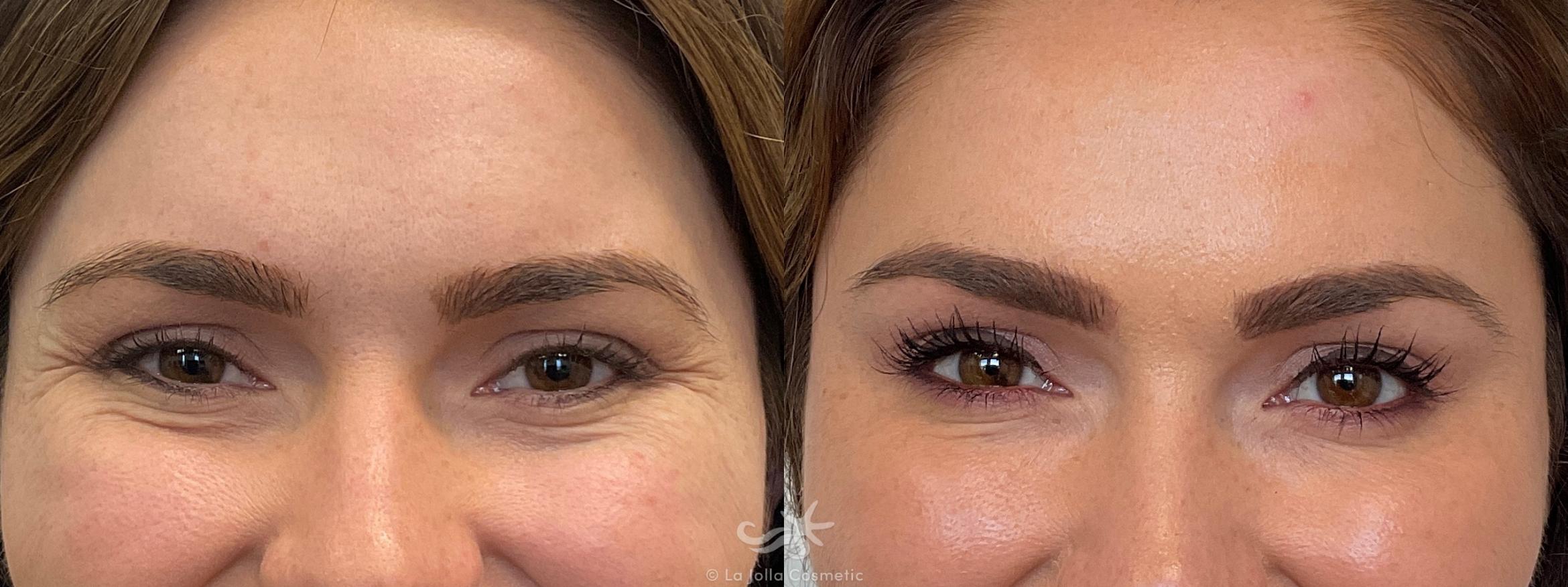Before & After BOTOX® Cosmetic Result 691 Front View in San Diego, Carlsbad, CA