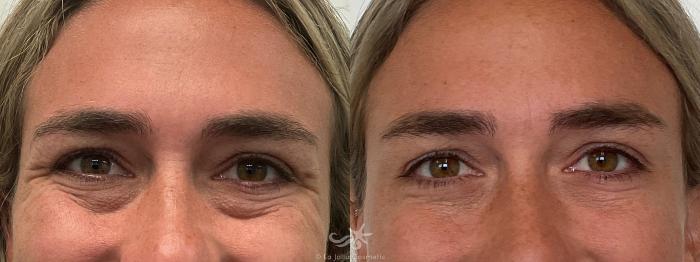 Before & After BOTOX® Cosmetic Result 707 Front View in San Diego, Carlsbad, CA