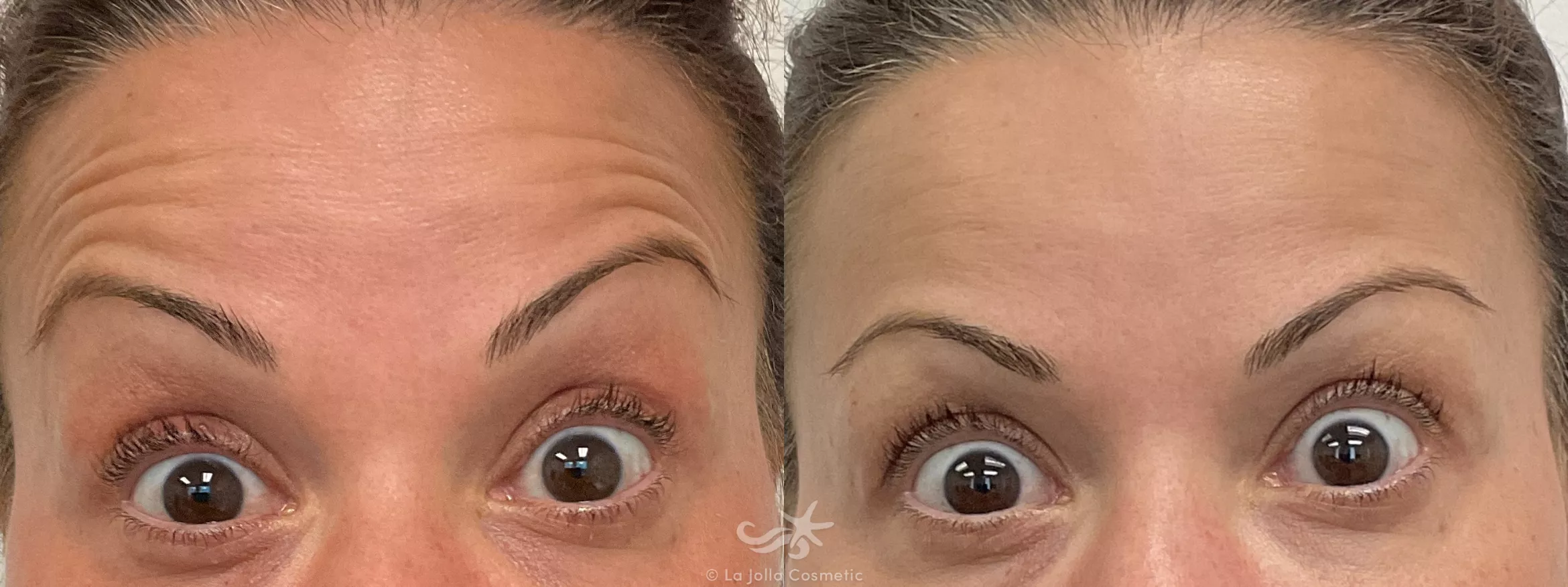 Before & After BOTOX® Cosmetic Result 735 Botox Forehead View in San Diego, CA