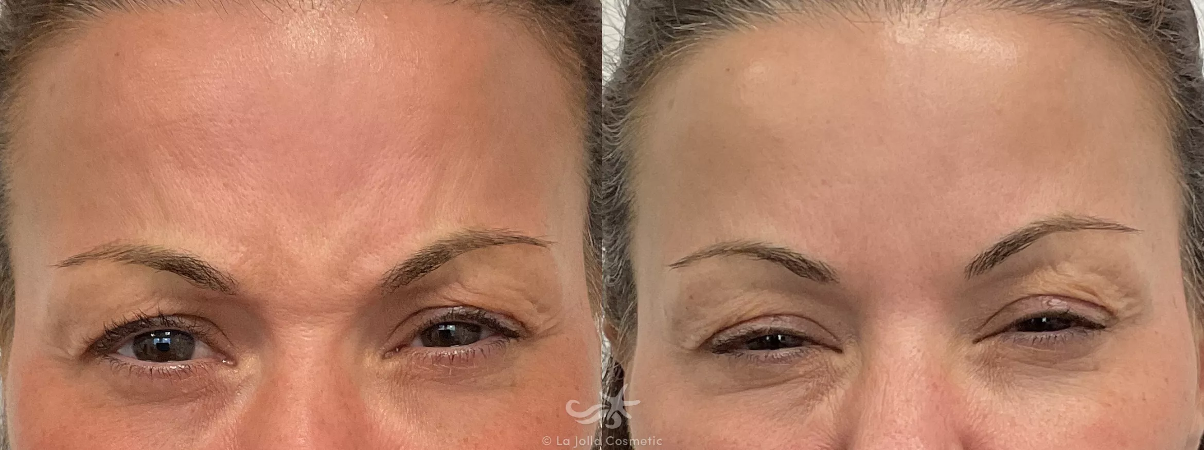 Before & After BOTOX® Cosmetic Result 735 Front View in San Diego, CA