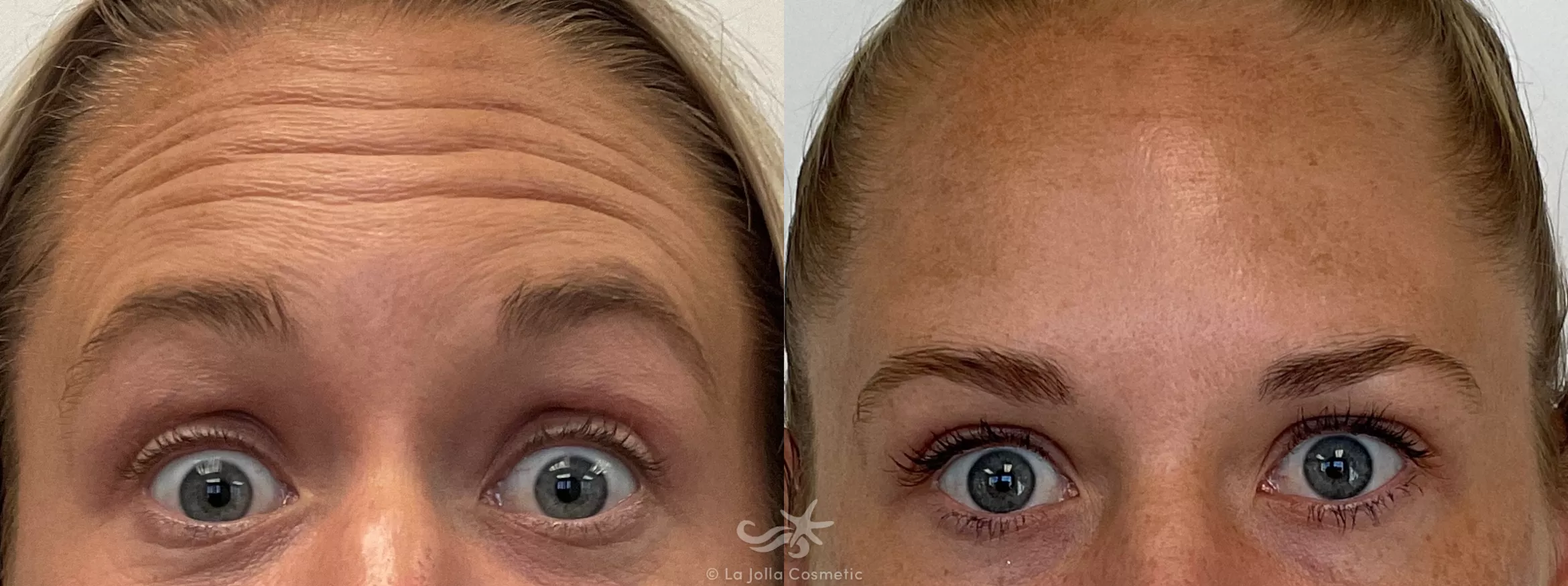 Before & After BOTOX® Cosmetic Result 736 Botox Forehead View in San Diego, CA