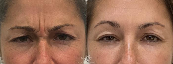 Before & After BOTOX® Cosmetic Result 756 Front Frown View in San Diego, Carlsbad, CA
