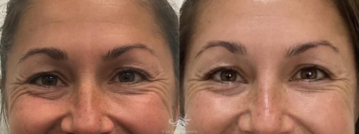 Before & After BOTOX® Cosmetic Result 756 Front View in San Diego, Carlsbad, CA