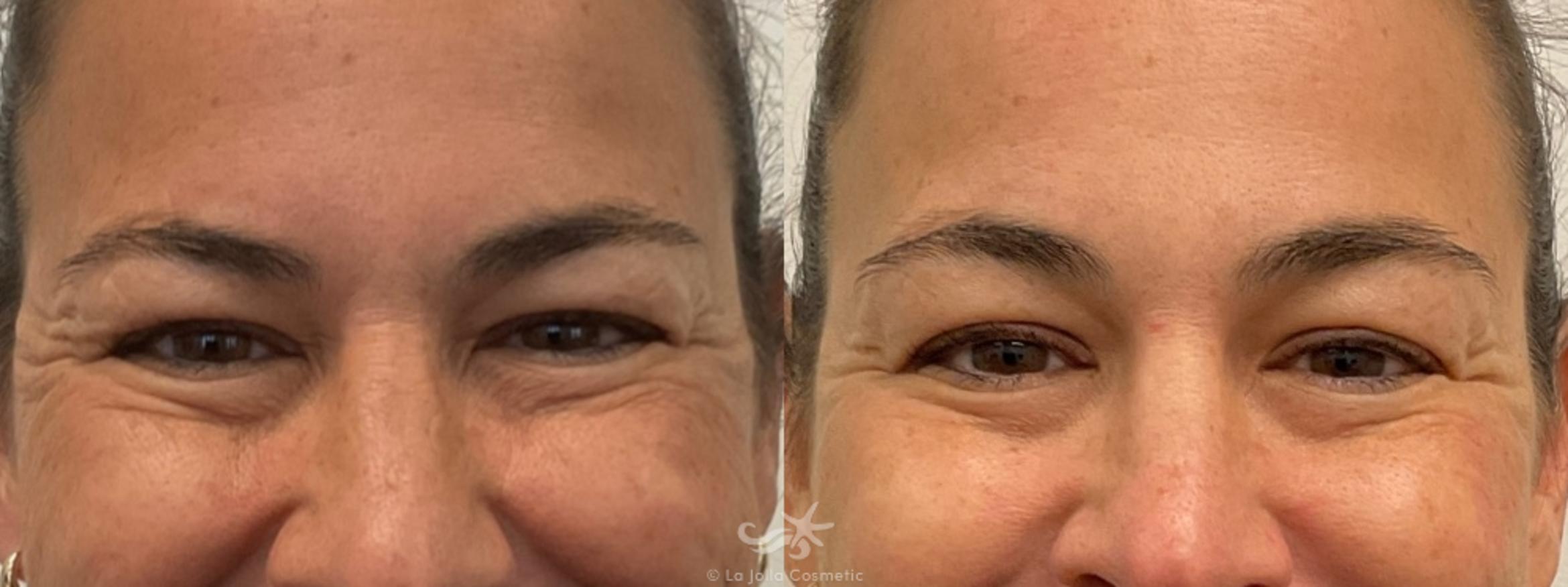 Before & After BOTOX® Cosmetic Result 768 Front View in San Diego, Carlsbad, CA