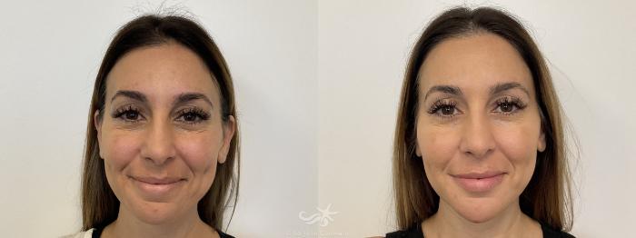 Before & After BOTOX® Cosmetic Result 772 Front View in San Diego, Carlsbad, CA