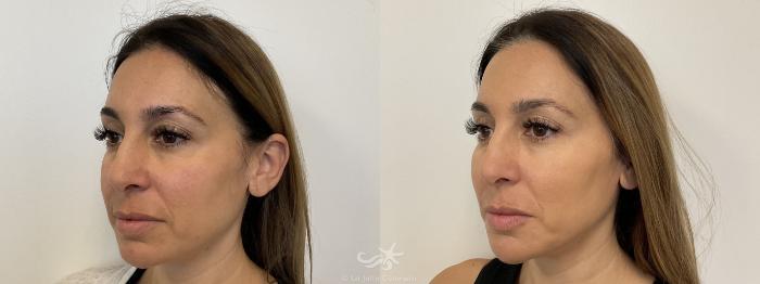 Before & After BOTOX® Cosmetic Result 772 Left Oblique View in San Diego, Carlsbad, CA