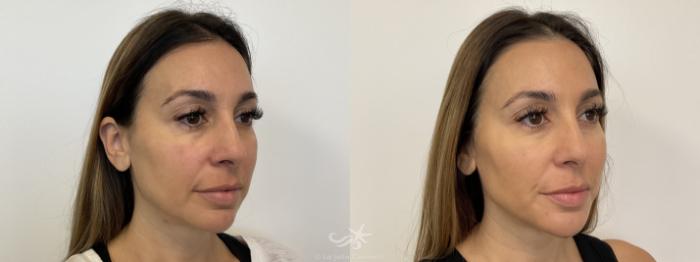 Before & After BOTOX® Cosmetic Result 772 Right Oblique View in San Diego, Carlsbad, CA