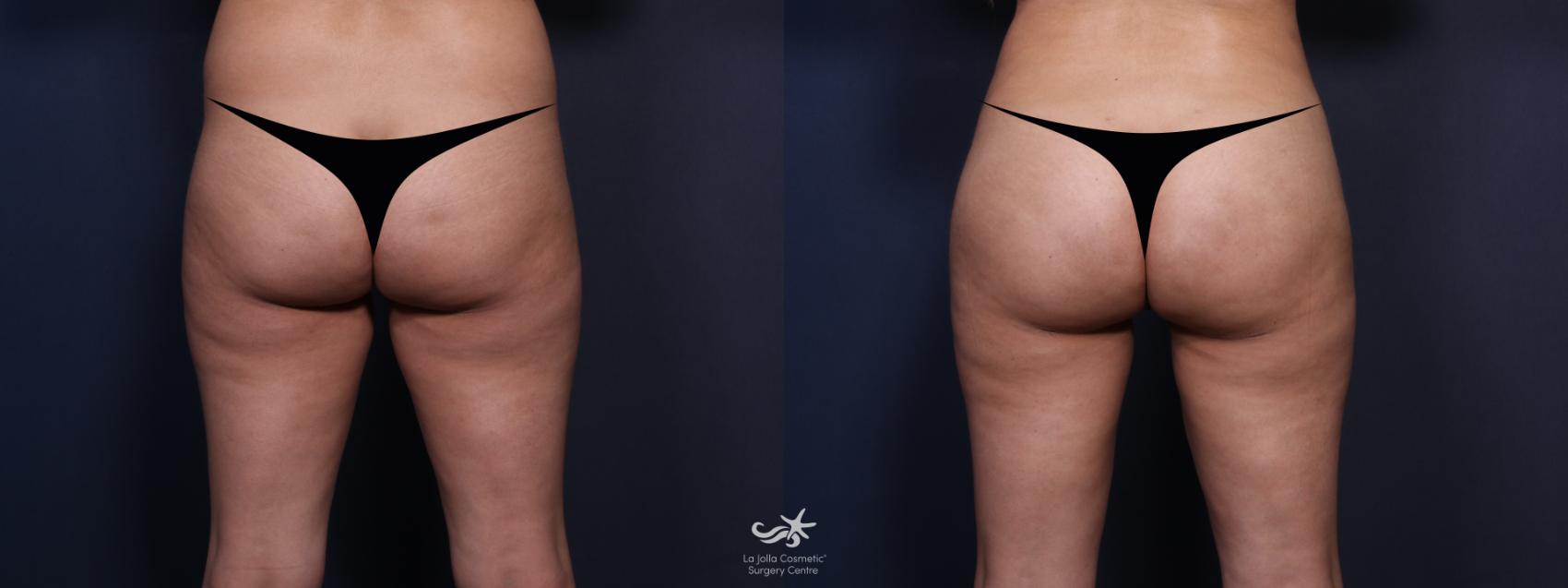 Brazilian Butt Lift - Center for Cosmetic Surgery in San Diego