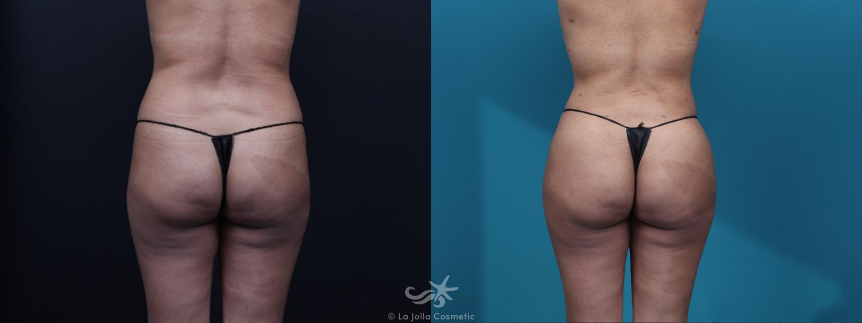 Before & After Brazilian Butt Lift Result 38 Back View in San Diego, CA