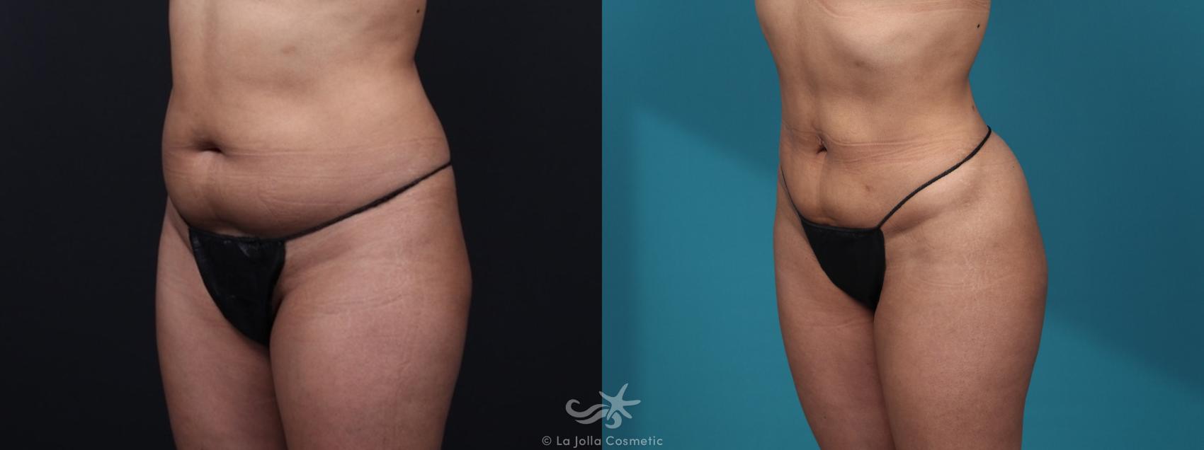 Before & After Brazilian Butt Lift Result 38 Left Oblique View in San Diego, CA