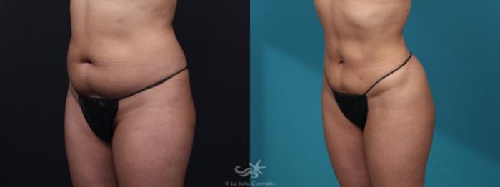 Before & After Brazilian Butt Lift Result 38 Left Oblique View in San Diego, Carlsbad, CA