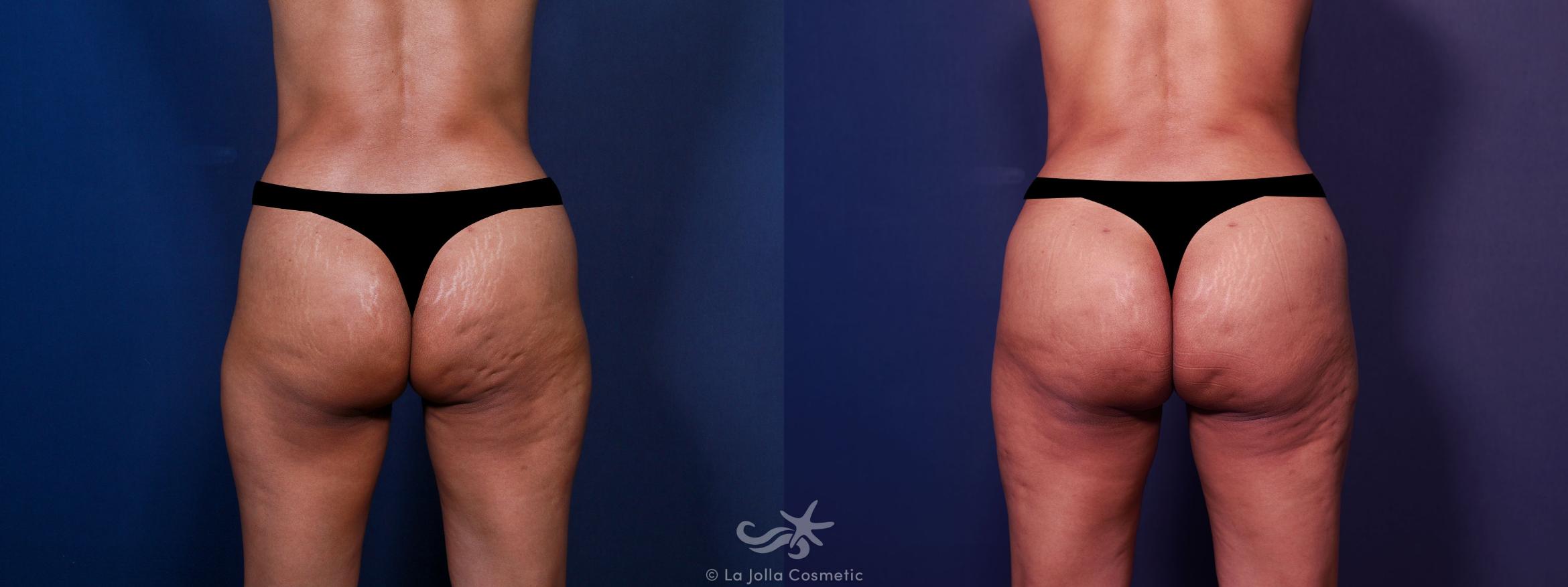 Before & After Brazilian Butt Lift Result 668 Back View in San Diego, Carlsbad, CA