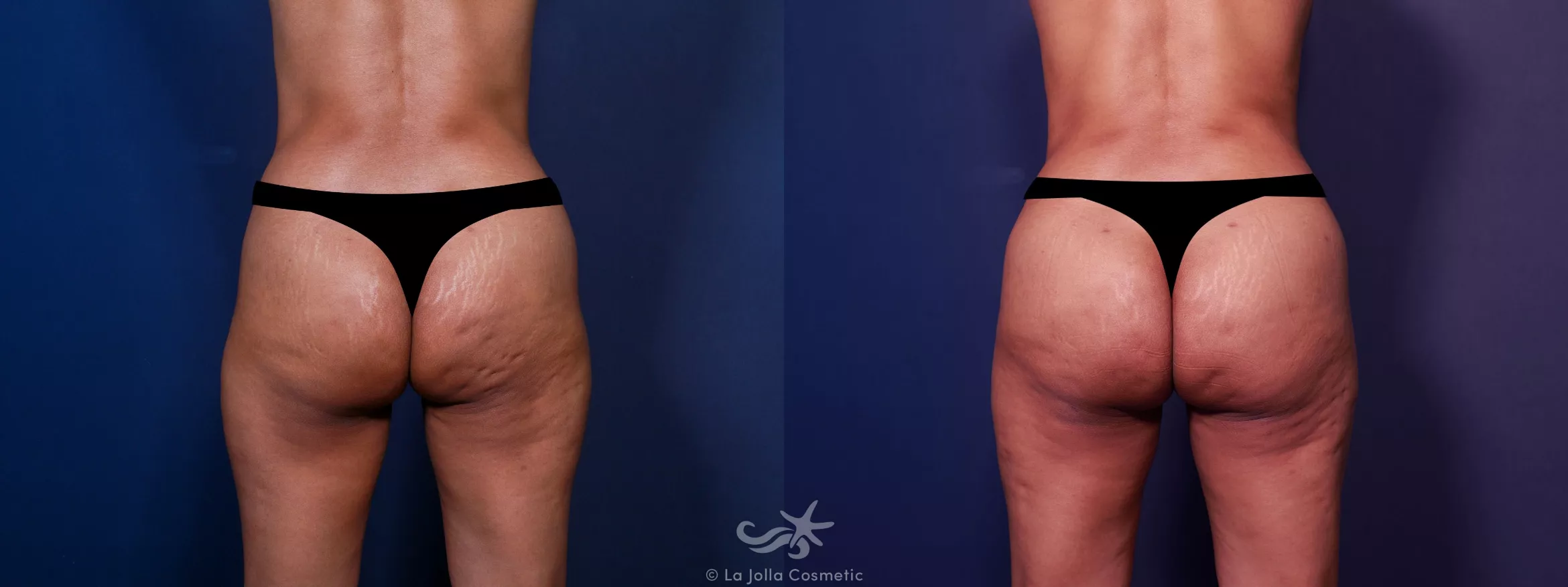 Before & After Brazilian Butt Lift Result 668 Back View in San Diego, CA