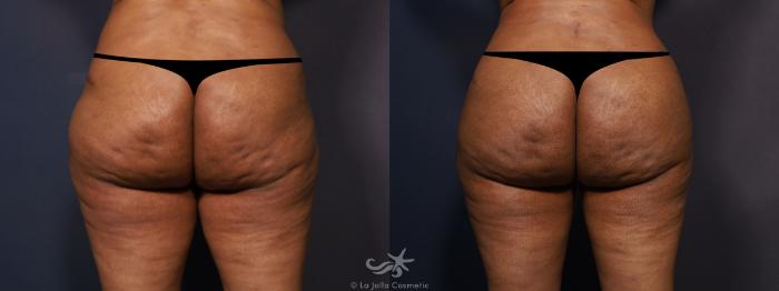 Before & After Brazilian Butt Lift Result 855 Back View in San Diego, Carlsbad, CA