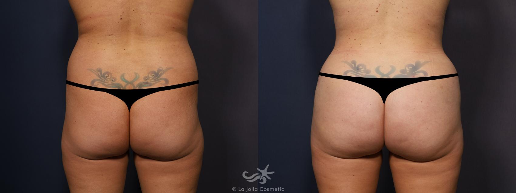 Before & After Brazilian Butt Lift Result 865 Back View in San Diego, CA