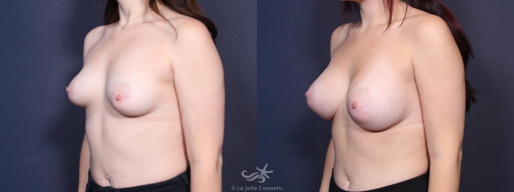 Before & After Breast Augmentation Result 100 Left Oblique View in San Diego, CA