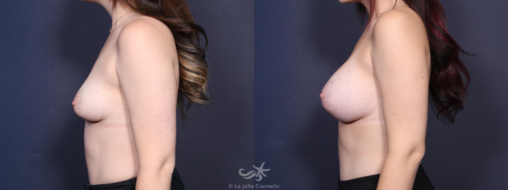 Before & After Breast Augmentation Result 100 Left Side View in San Diego, CA
